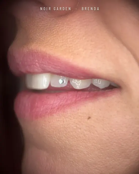 Gema dental brillante en un incisivo lateral