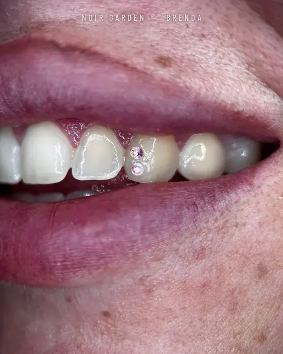 Dos gemas dentales tornasoladas en un colmillo