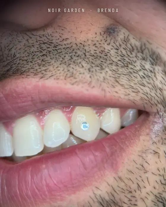 Gema dental redonda en un incisivo lateral