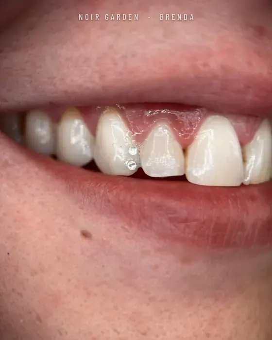 Dos gemas dentales pequeñas en fila