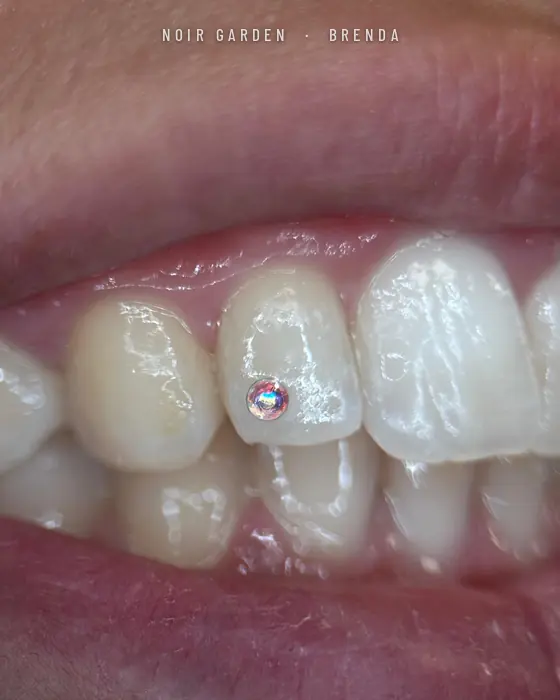 Gema dental tornasolada en un incisivo lateral