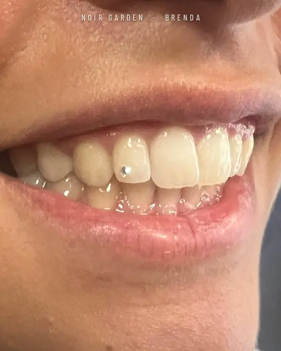 Gema dental brillante en un incisivo lateral
