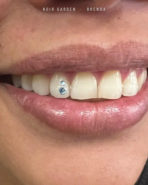 Dos gemas dentales azules en un incisivo lateral
